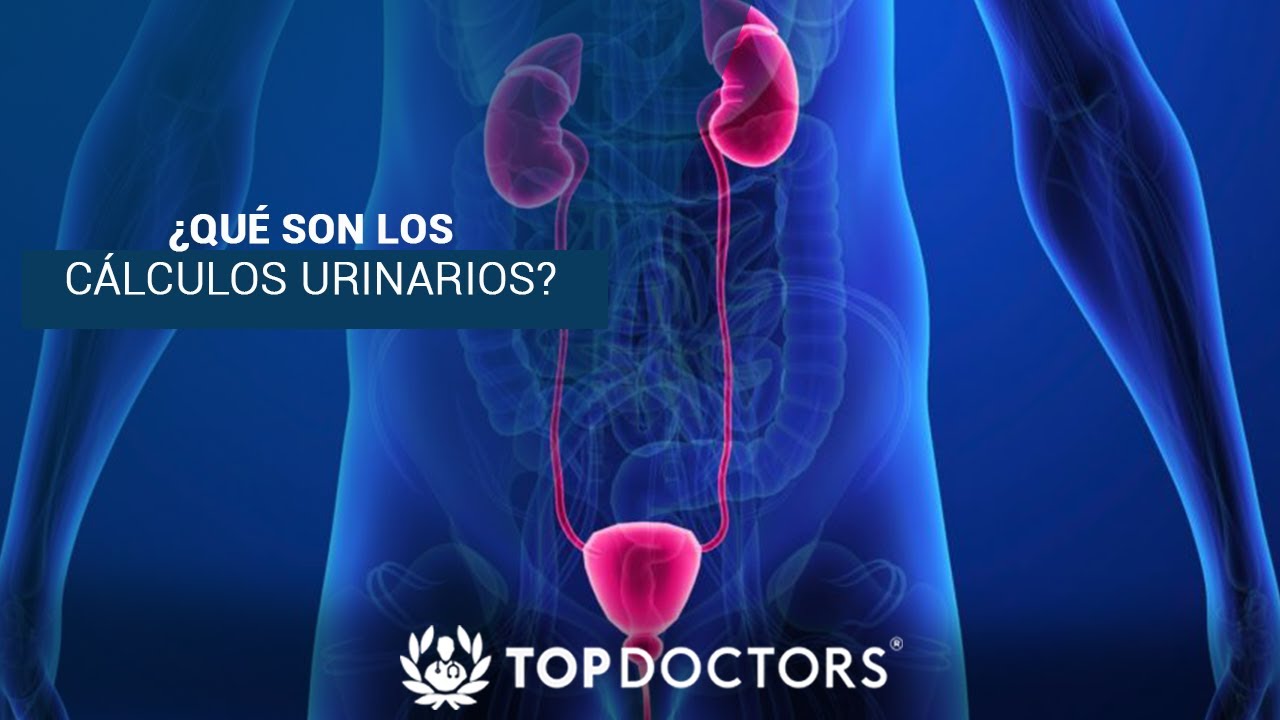 &iquest;Qu&eacute; son los C&aacute;lculos Urinarios?