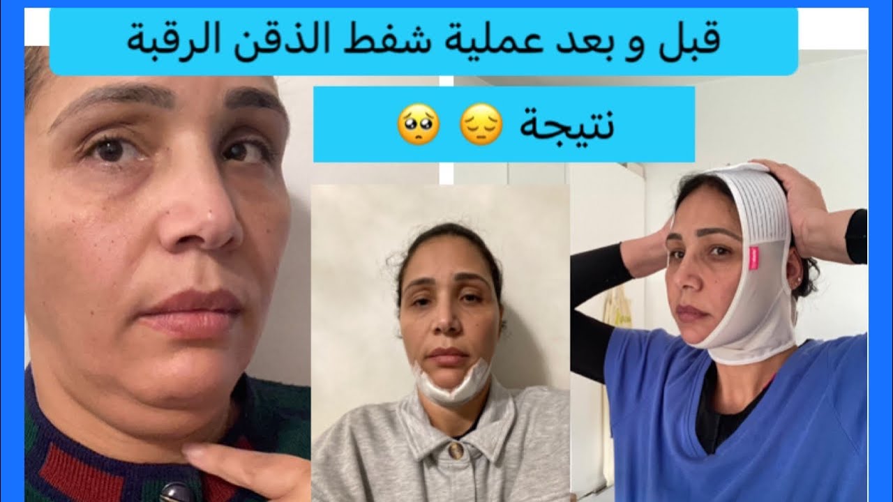 عملية فاشلة 😭شفط اللغلوغ (الذقن -الرقبة)فيديوات تجميل البطن شفط و الشد في صندوق الوصف👇