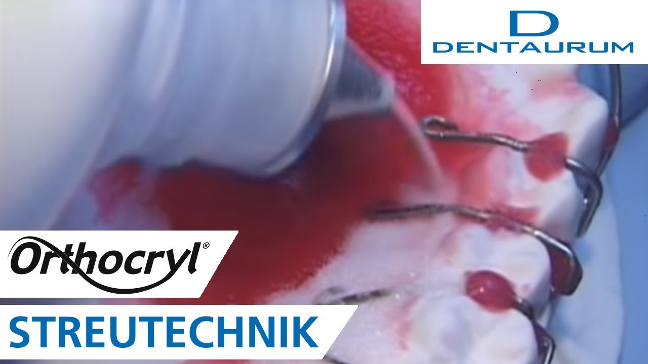 Orthocryl®: Herstellung einer herausnehmbaren Zahnspange in der Streutechnik