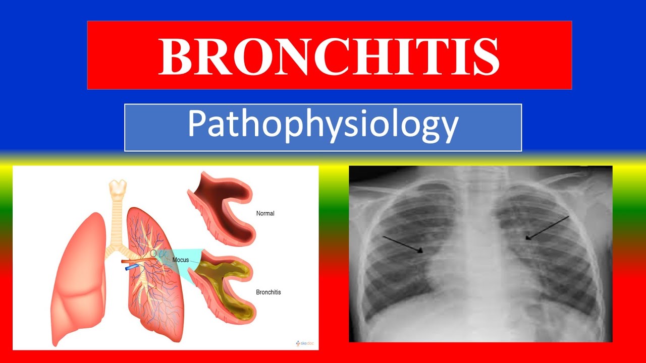 BRONCHITIS -Pathophysiology  &ndash; Step-by-Step  Process Explained