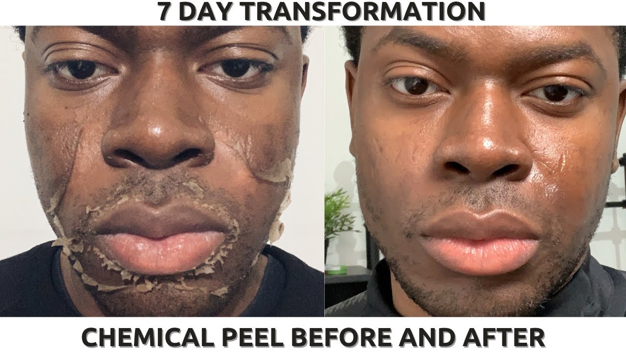 CHEMICAL PEEL ON BLACK SKIN | FULL PROCESS BEFORE & AFTER | HYPERPIGMENTATION & DARK SPOTS