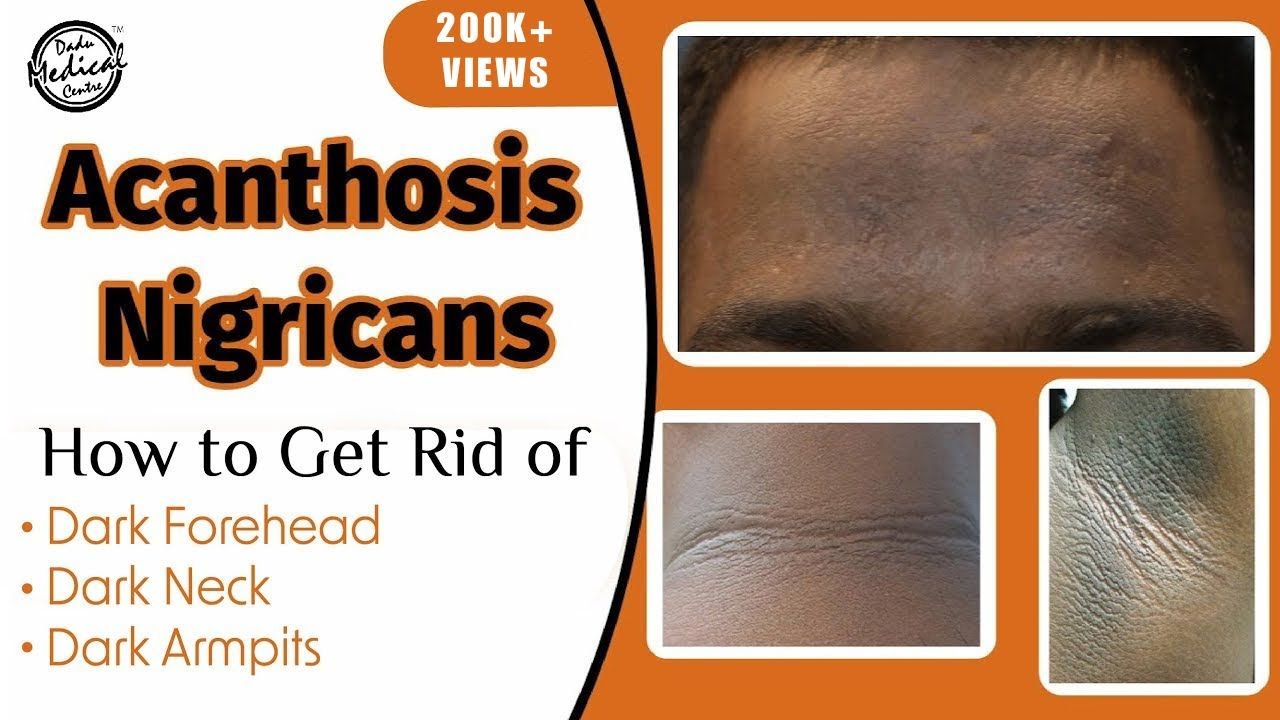 Acanthosis Nigricans: How to Get Rid of Dark Neck & Armpits? | Dr. Nivedita Dadu
