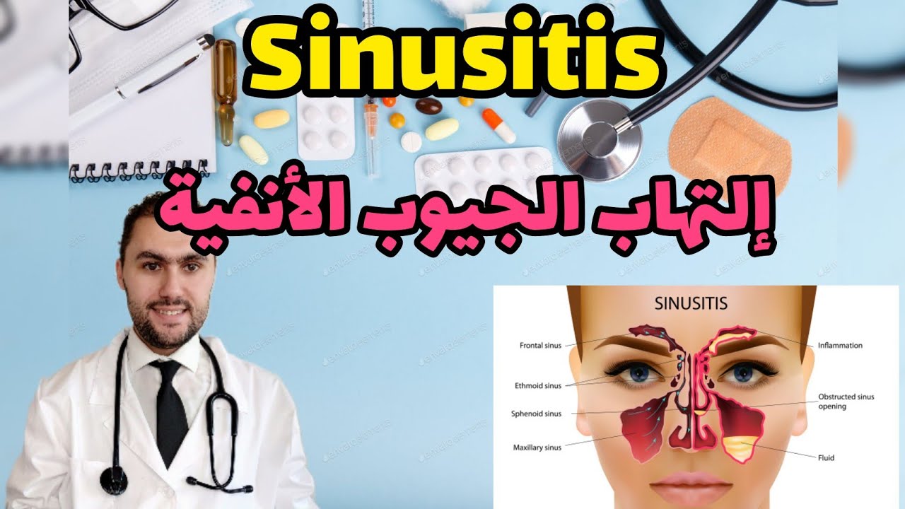 إلتهاب الجيوب الأنفية | السينوزيت| ماهي ؟ | الأعراض |  الأسباب | العلاج | الوقاية
