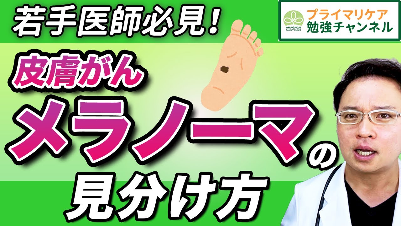 【皮膚がん 見た目からの初期症状の見分け方】ほくろとの見分け方【 詳しく解説! 若手医師必見】