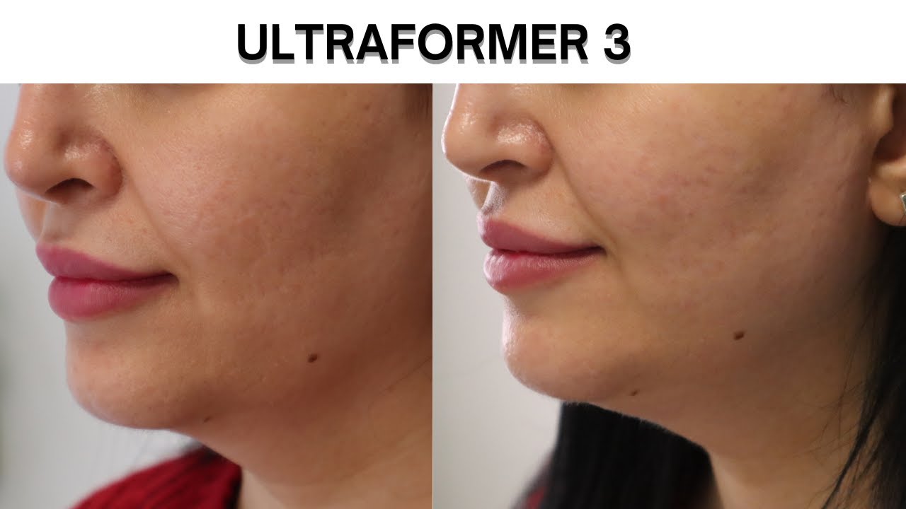 Was ist ein HIFU FACELIFTING? Was passiert während der Behandlung - ULTRAFORMER 3 / MMFU