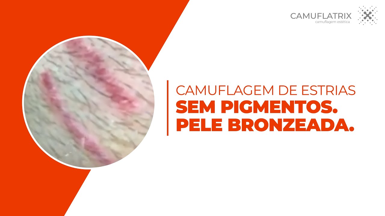 CAMUFLAGEM DE ESTRIAS - SEM PIGMENTOS! PELE BRONZEADA! - LUCAS CASTRO | CAMUFLATRIX
