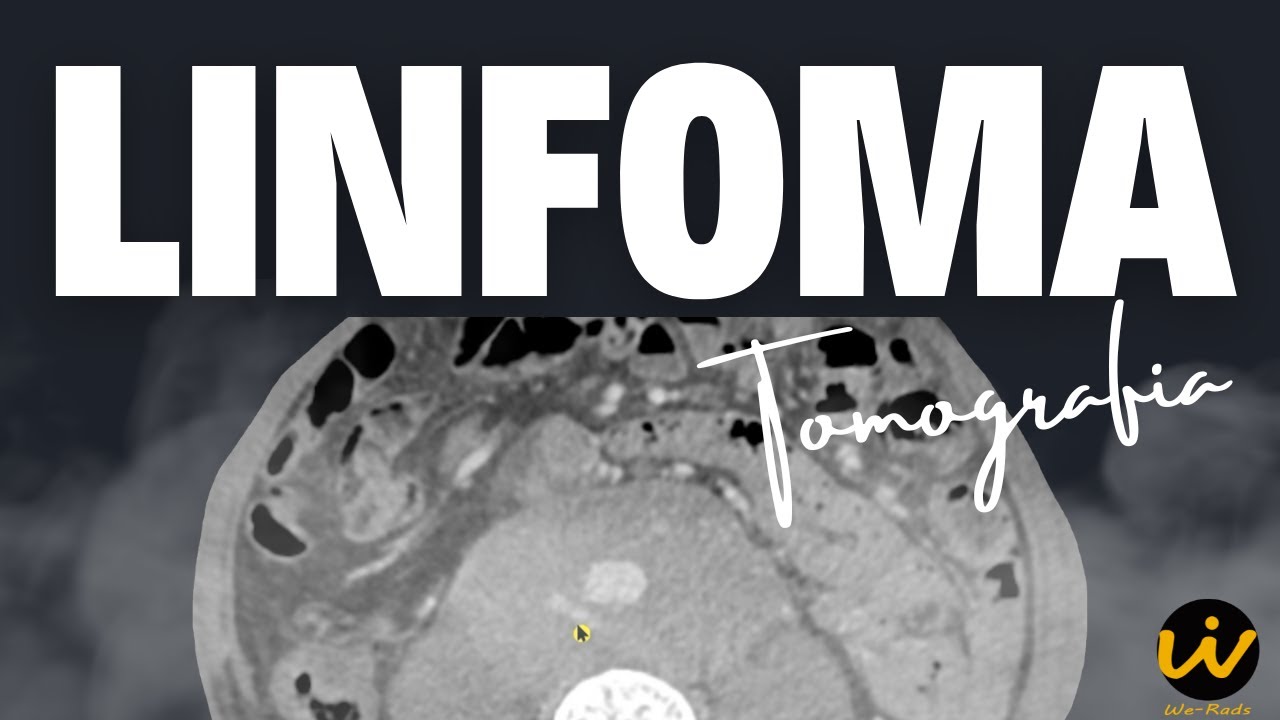 LINFOMA na Tomografia de Tórax, Abdome e Pelve