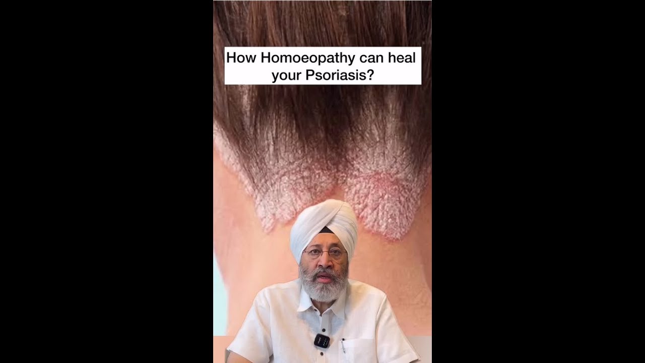 How Homoeopathy Can Heal Your Psoriasis? | Bakson's Homoeopathy