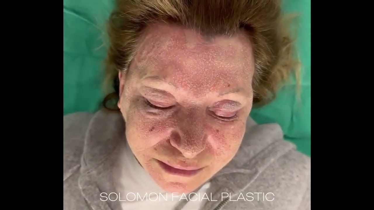 CO2 and Erbium Laser Resurfacing for Facial Rejuvenation | Dr. Philip Solomon