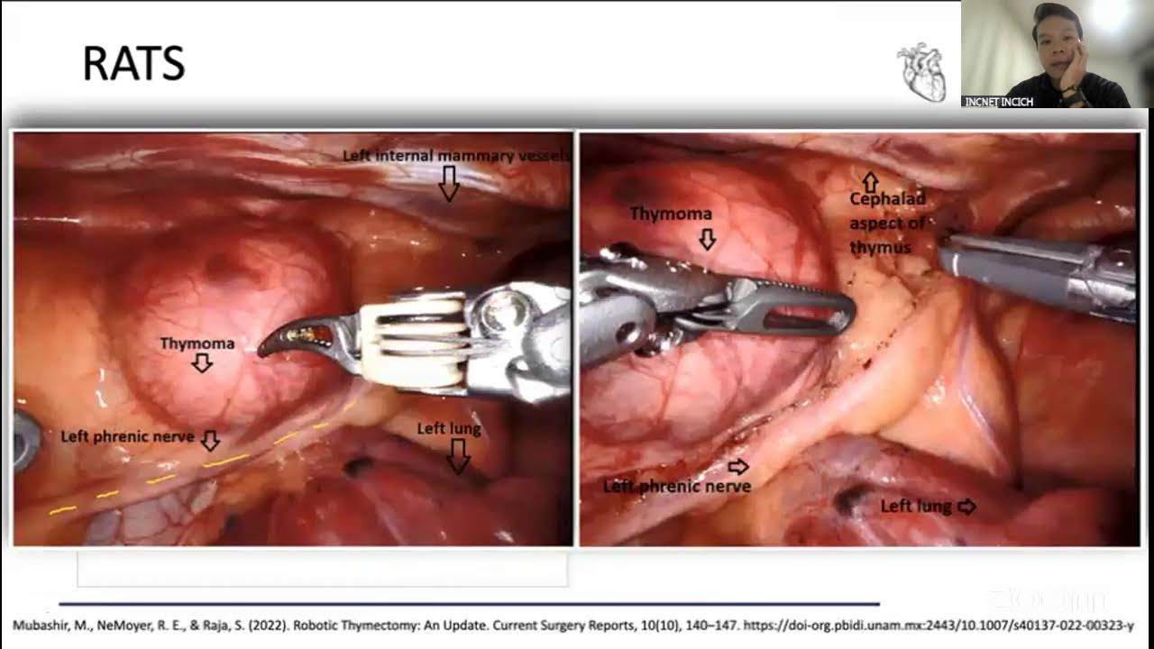 TIMOMA Y CARCINOMA TIMICO