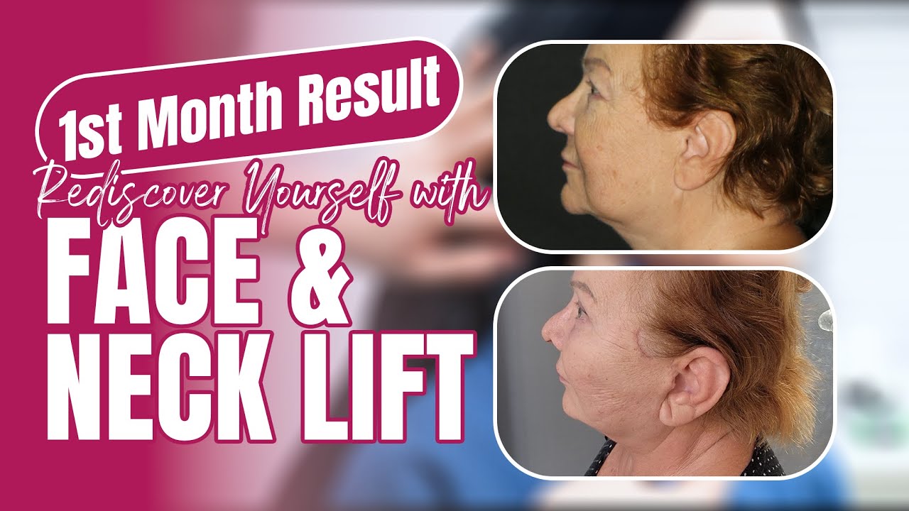Barbara’s Facelift and Neck Lift Journey in Turkey | Akm Clinic
