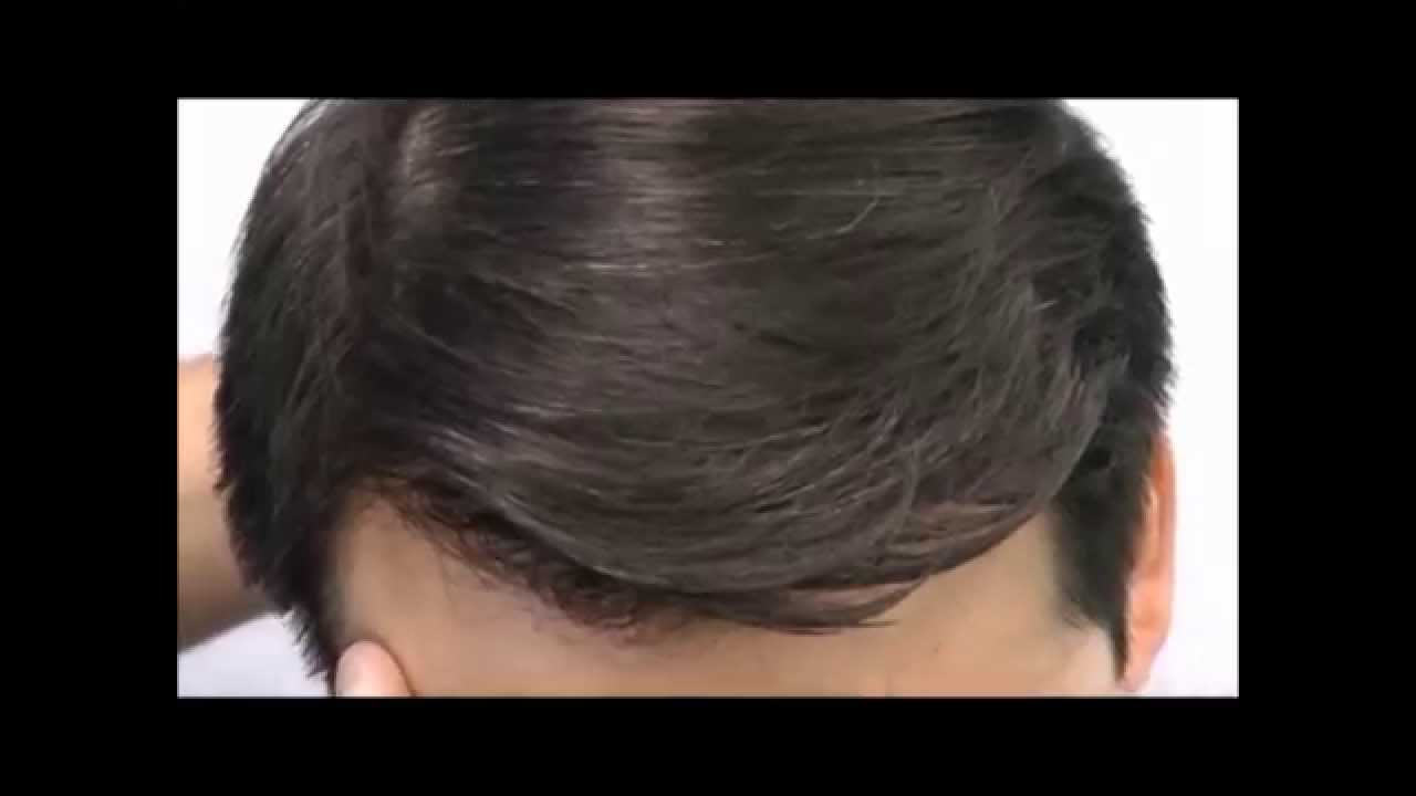 Asian Hair Transplant Patient 8 Months Post-Op | Sure Hair International Toronto, Ontario