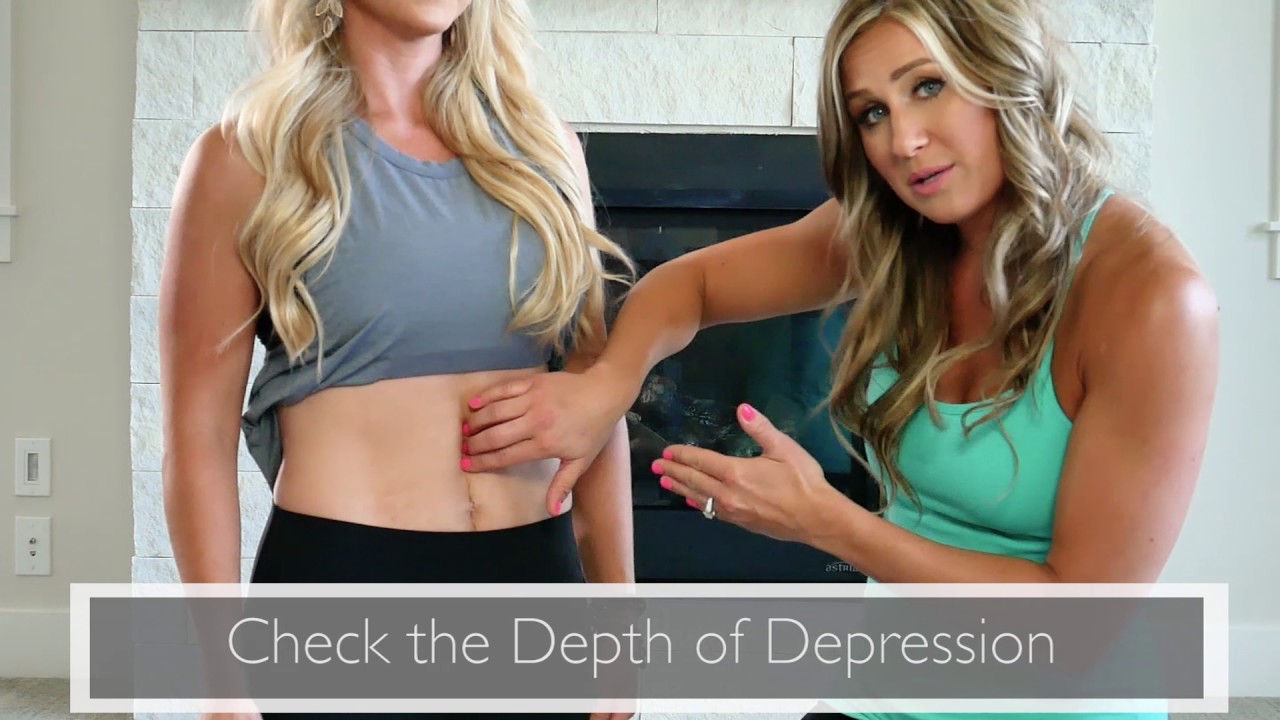 How to Check to See if You Have Diastasis Recti
