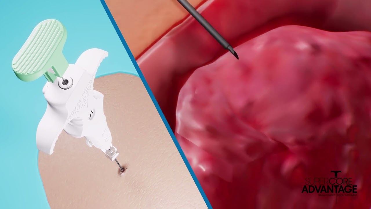 SuperCore Advantage™ Semi-Automatic Biopsy Instrument