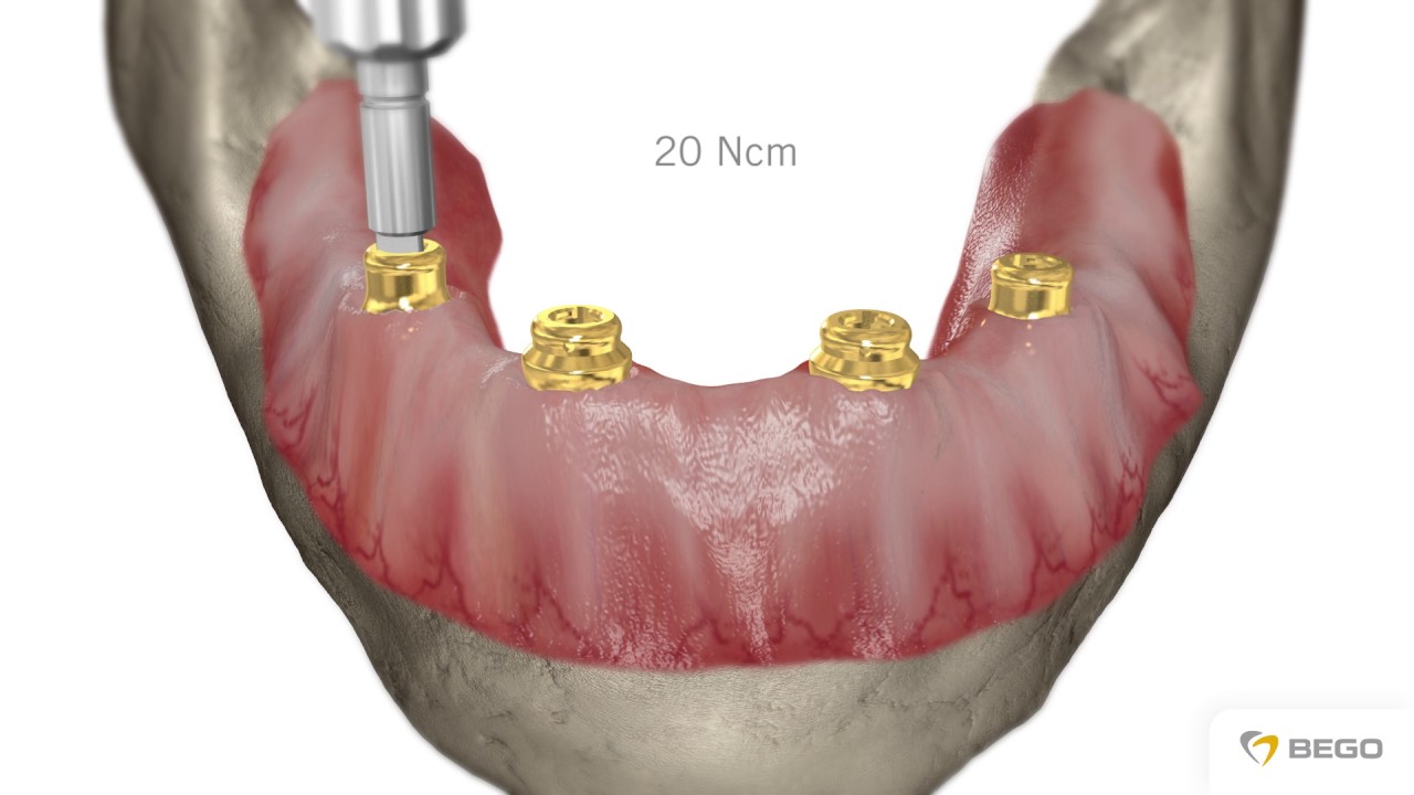 BEGO Implant Systems – MultiPlus MC