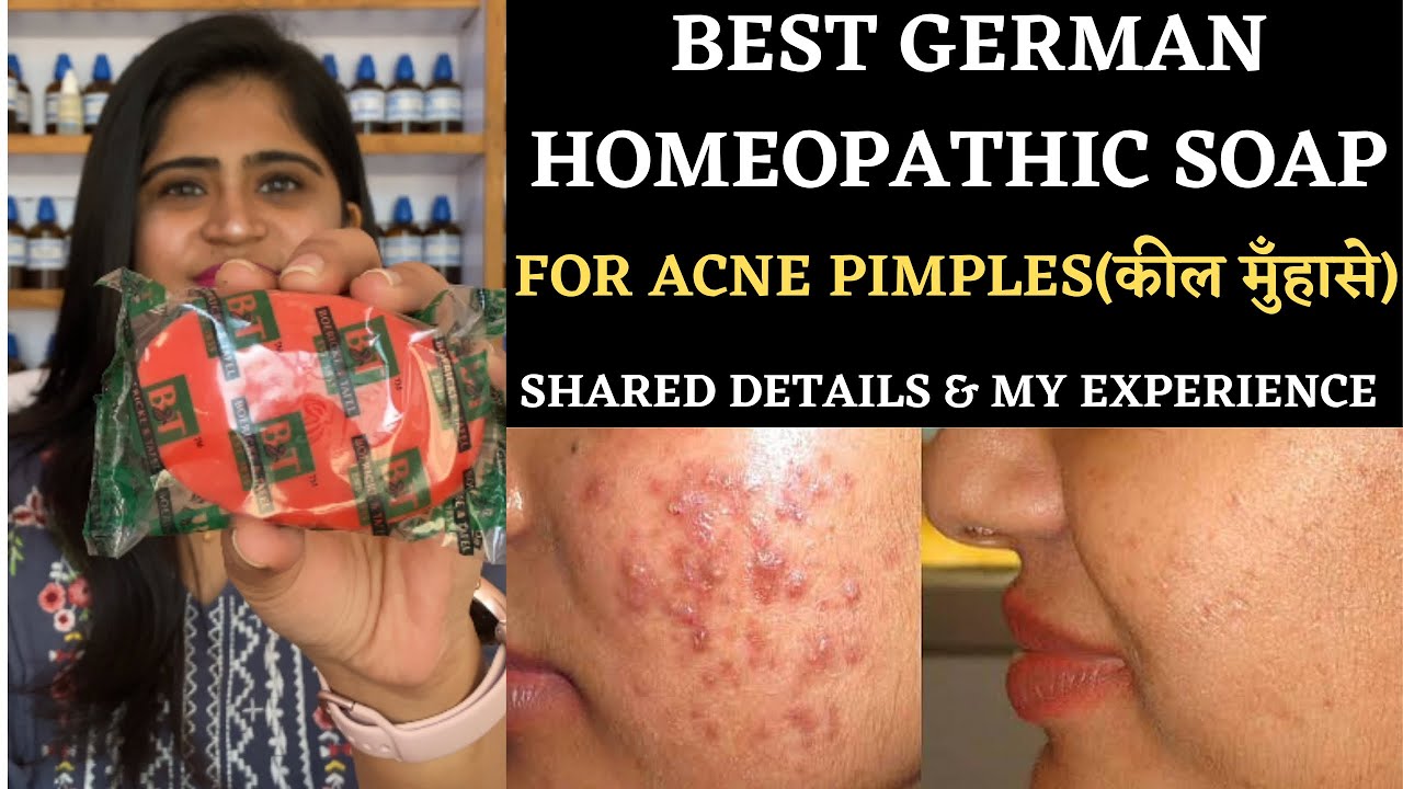 Best Homeopathic Soap For Acne Pimples And Boils || German Akne Sor Soap || #drarwabohra