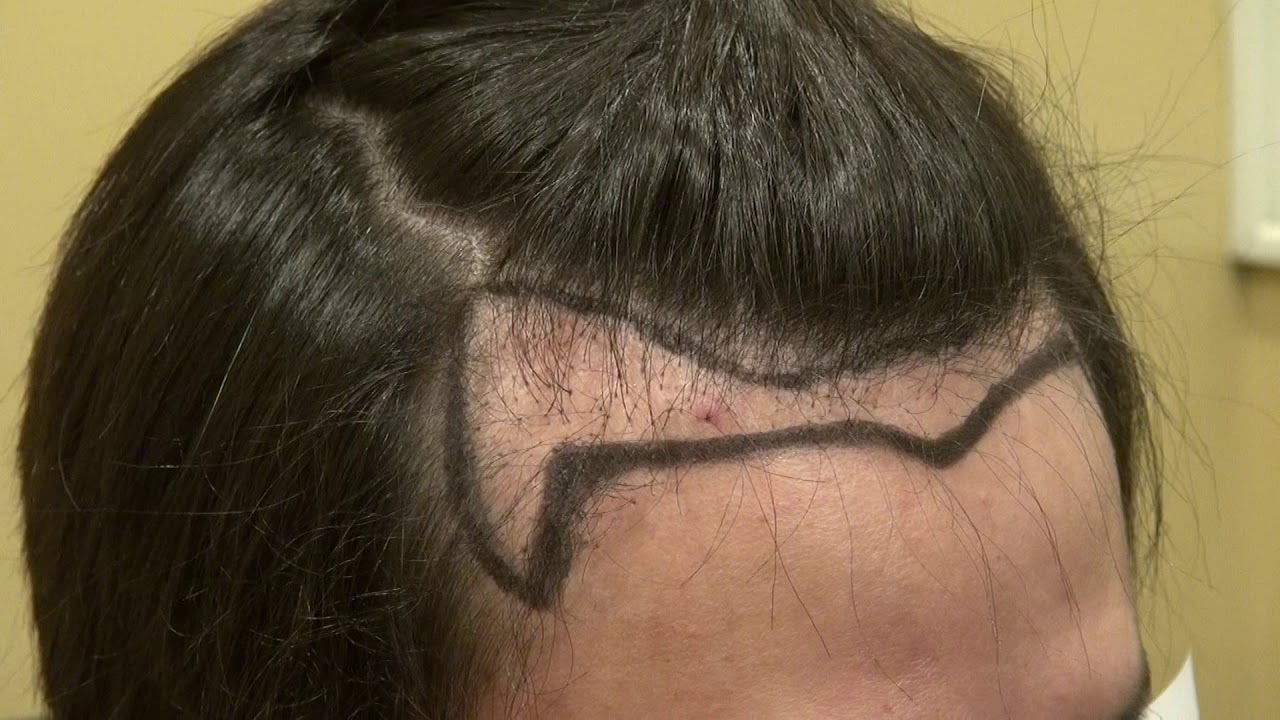 Rebuilding A Hair Line by Dr. Diep by Dr.Diep http://www.mhtaclinic.com