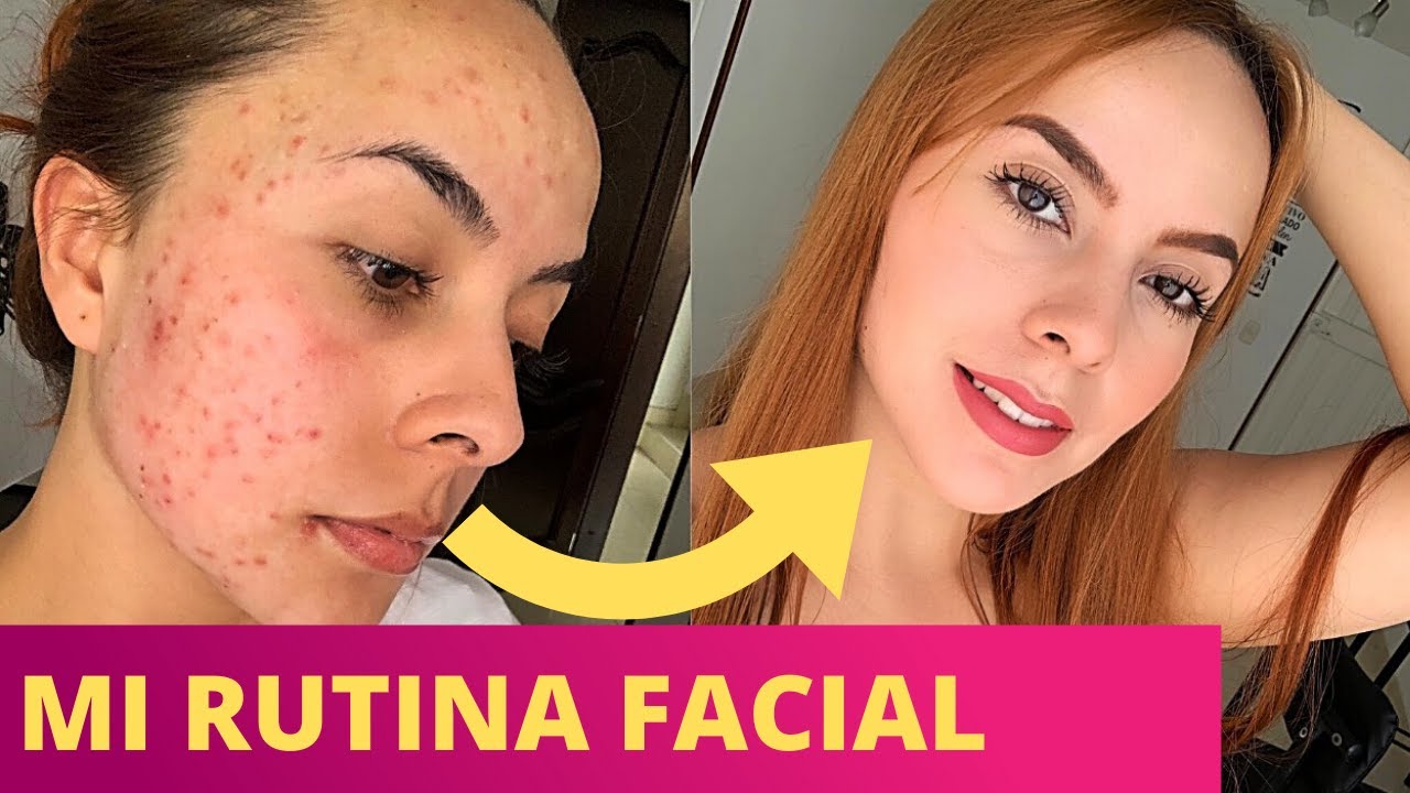 COMO ME CURE DEL ACNE + MIS PRODUCTOS DE CUIDADO FACIAL |Karomakeup|