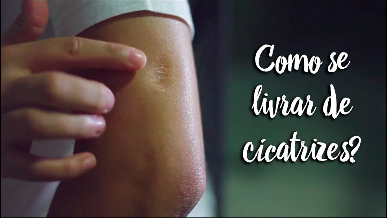 Fica a Dica - Como se livrar de cicatrizes? - by Farmácias Pague Menos