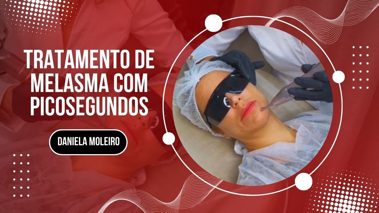 Tratamento de Melasma com Picosegundos Ômer Premium Medical San
