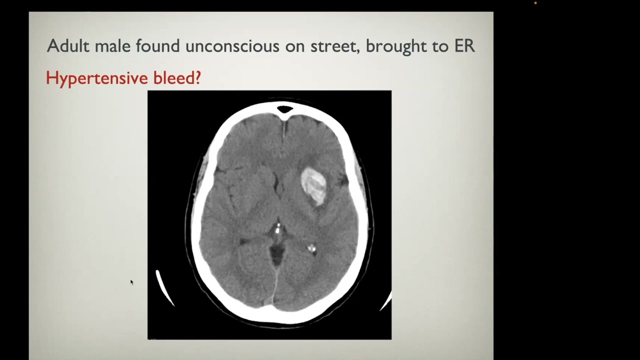 week 5 imaing of brain hemorrhage   HD 1080p