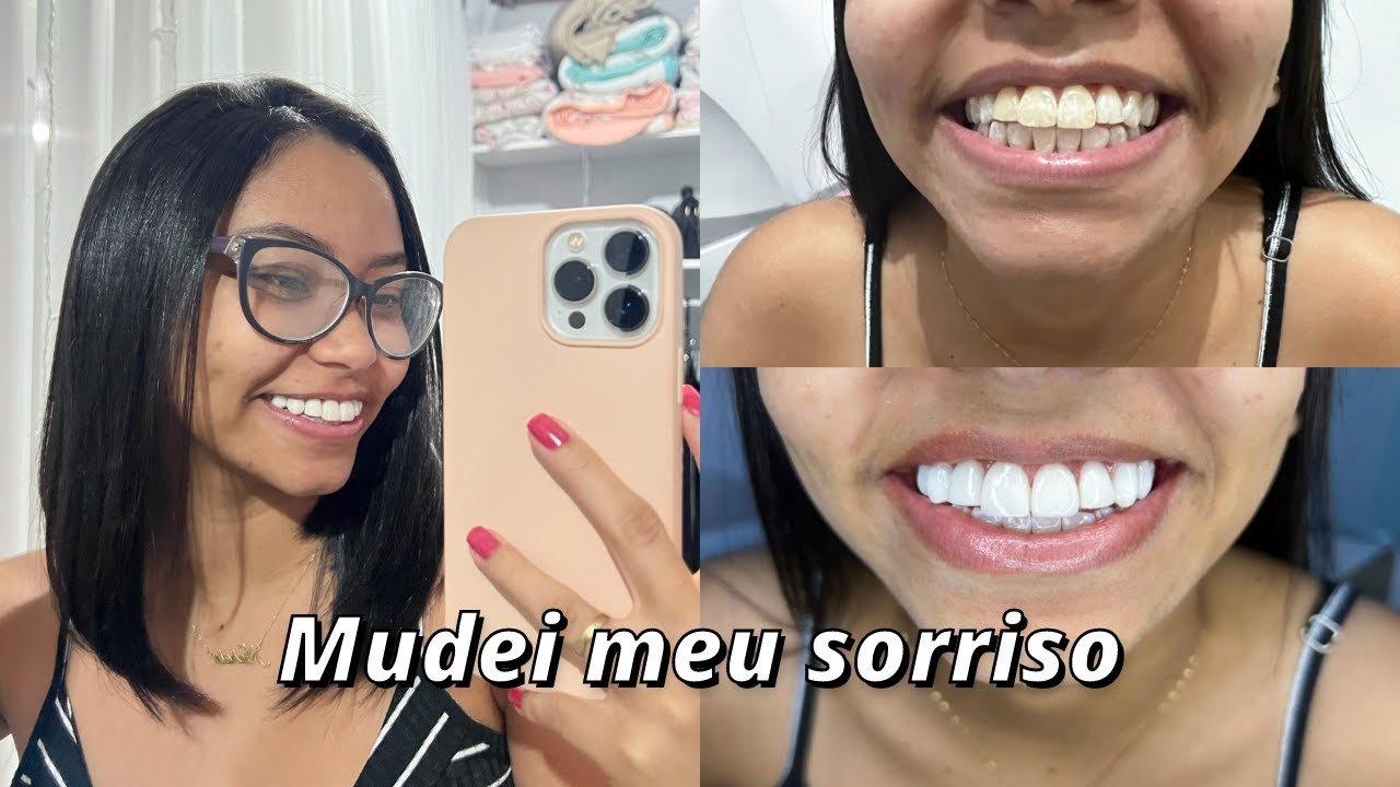 FACETAS DE RESINA | sorriso novo, dor, preço e mais