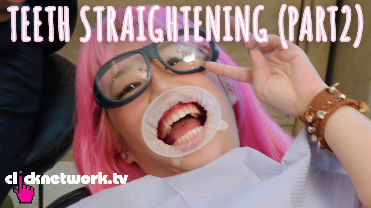 Teeth Straightening (Part2) - Xiaxue's Guide To Life: EP107
