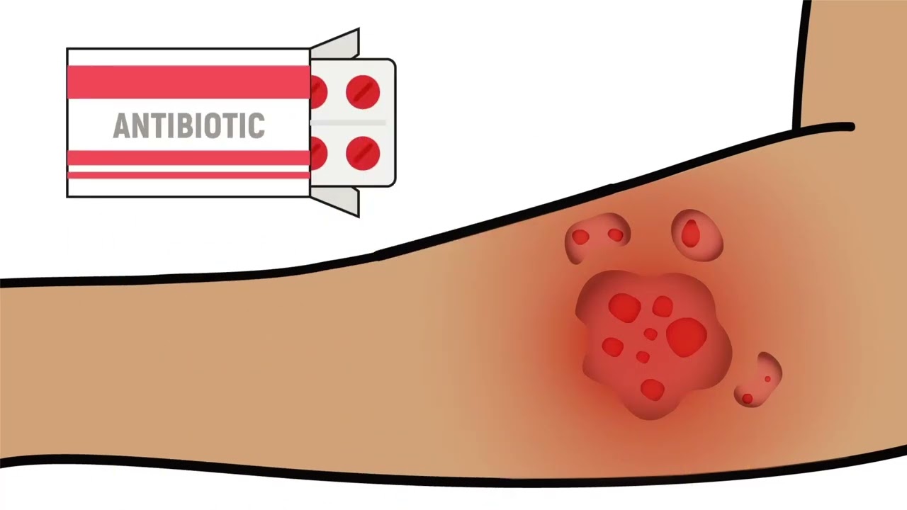 Xylazine 102: Focus on Wound Care
