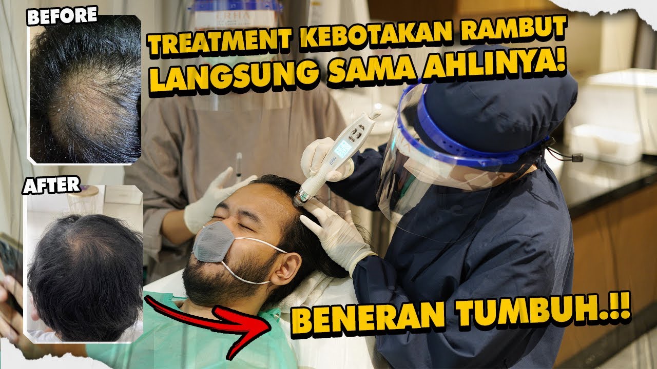 3 PENYEBAB RAMBUT KEBOTAKAN DINI DAN CARA MELEBATKAN RAMBUT TIPIS