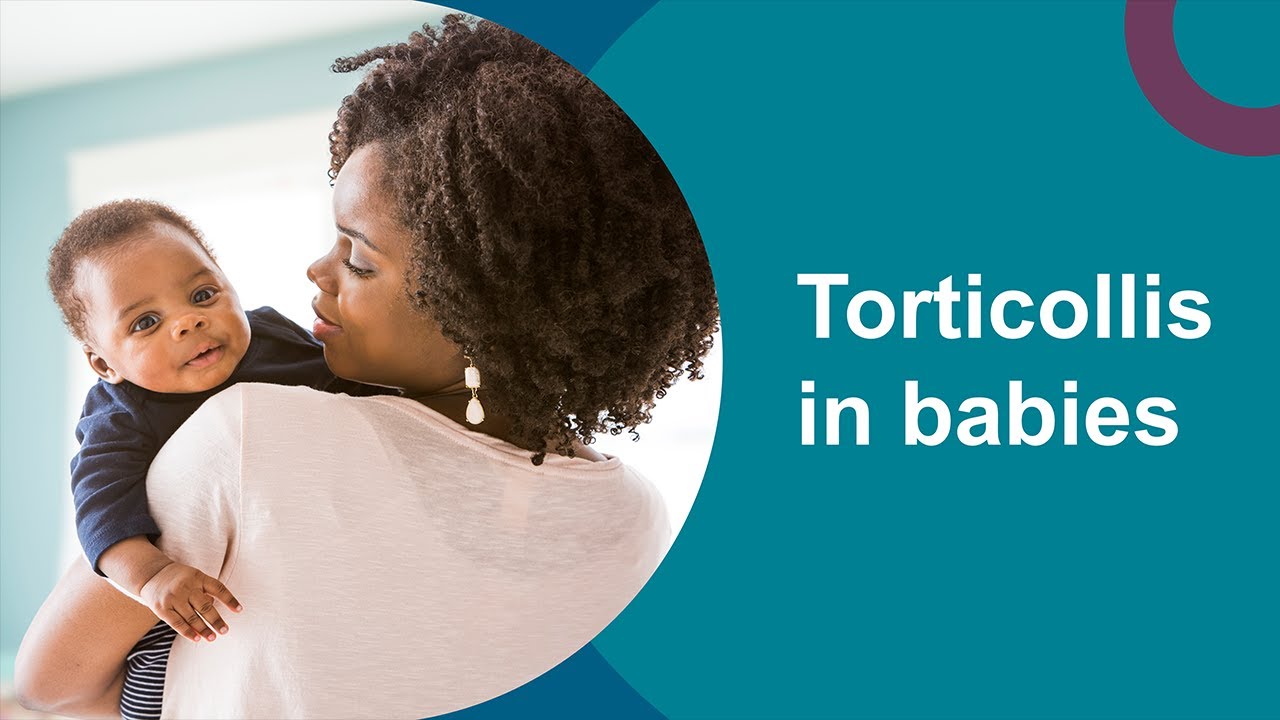 Torticollis in babies: Neck movement and head shape