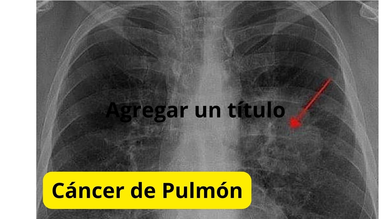 Cáncer de pulmón