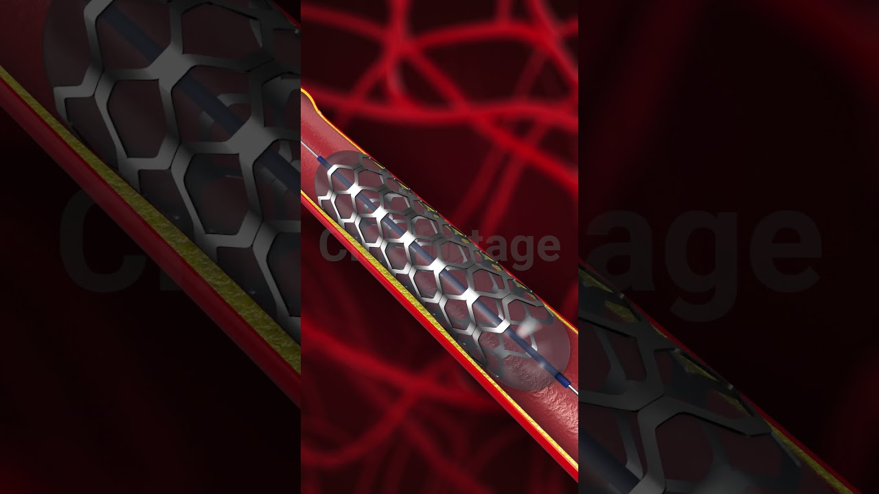 Circulatory Support with Vascular Stent Implantation stock footage | stock video | Cinefootage