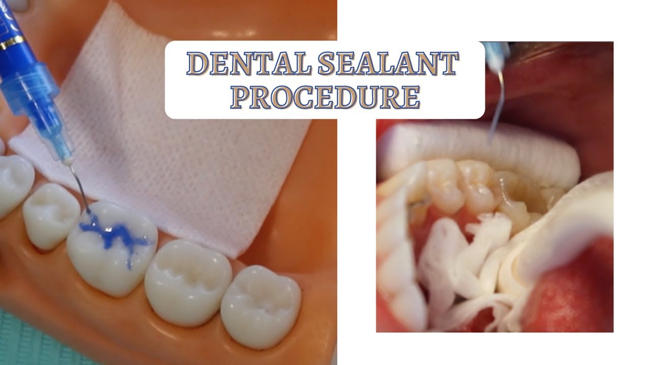 How to Apply a Dental Sealant | Wet vs Dry Environment
