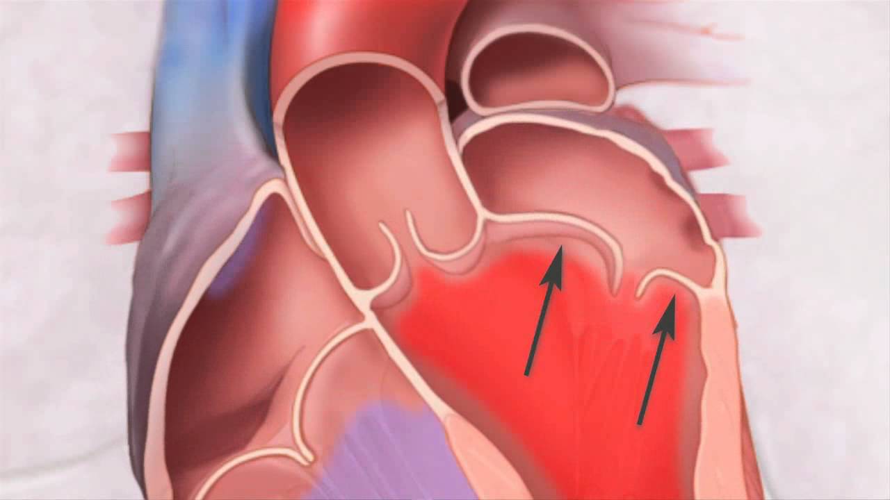 Prolapso da Válvula Mitral: o que é?