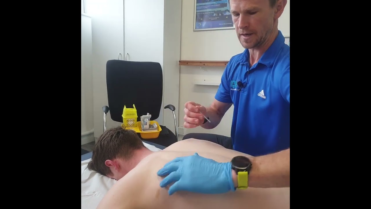 Dry Needling for Shoulder Pain