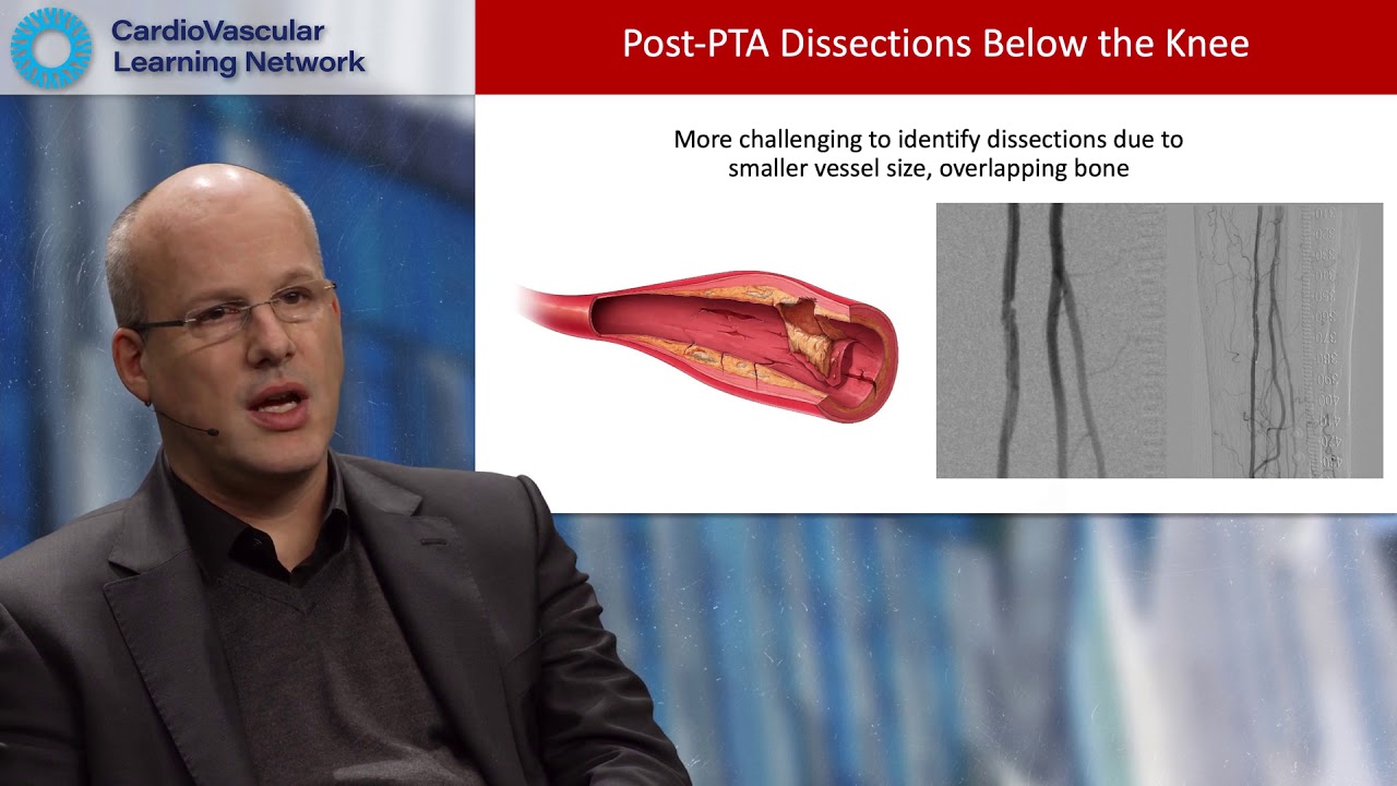 Critical Limb Ischemia: Best Practices for Addressing Calcification