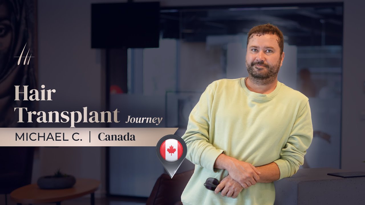 DHI Hair TransplantResult (Norwood Scale 4) ✨ Michael C. Transformation