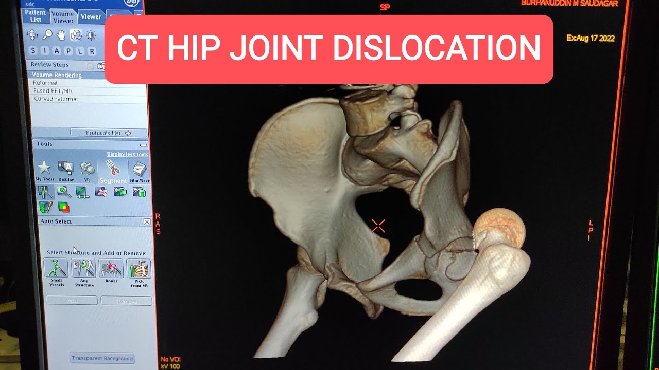 Hip Dislocations - 3D CT Hip Joint Posterior Dislocation.