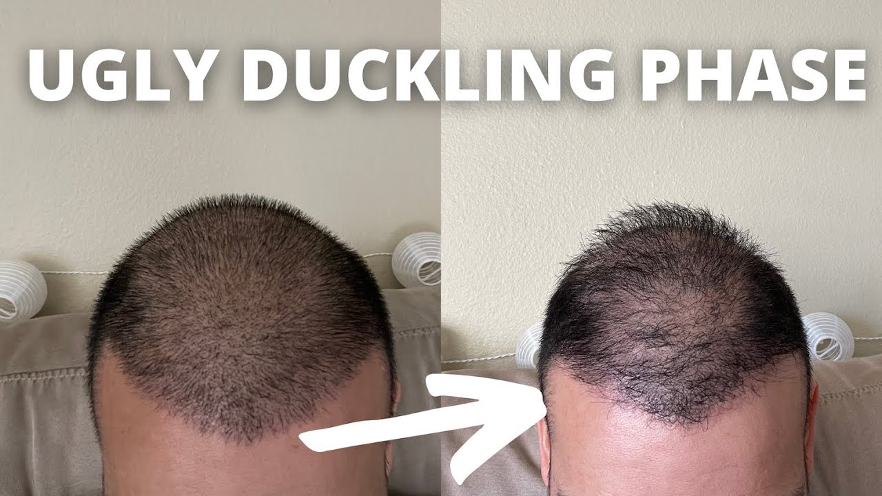 The Ugly Duckling Phase Everything You Need To Know