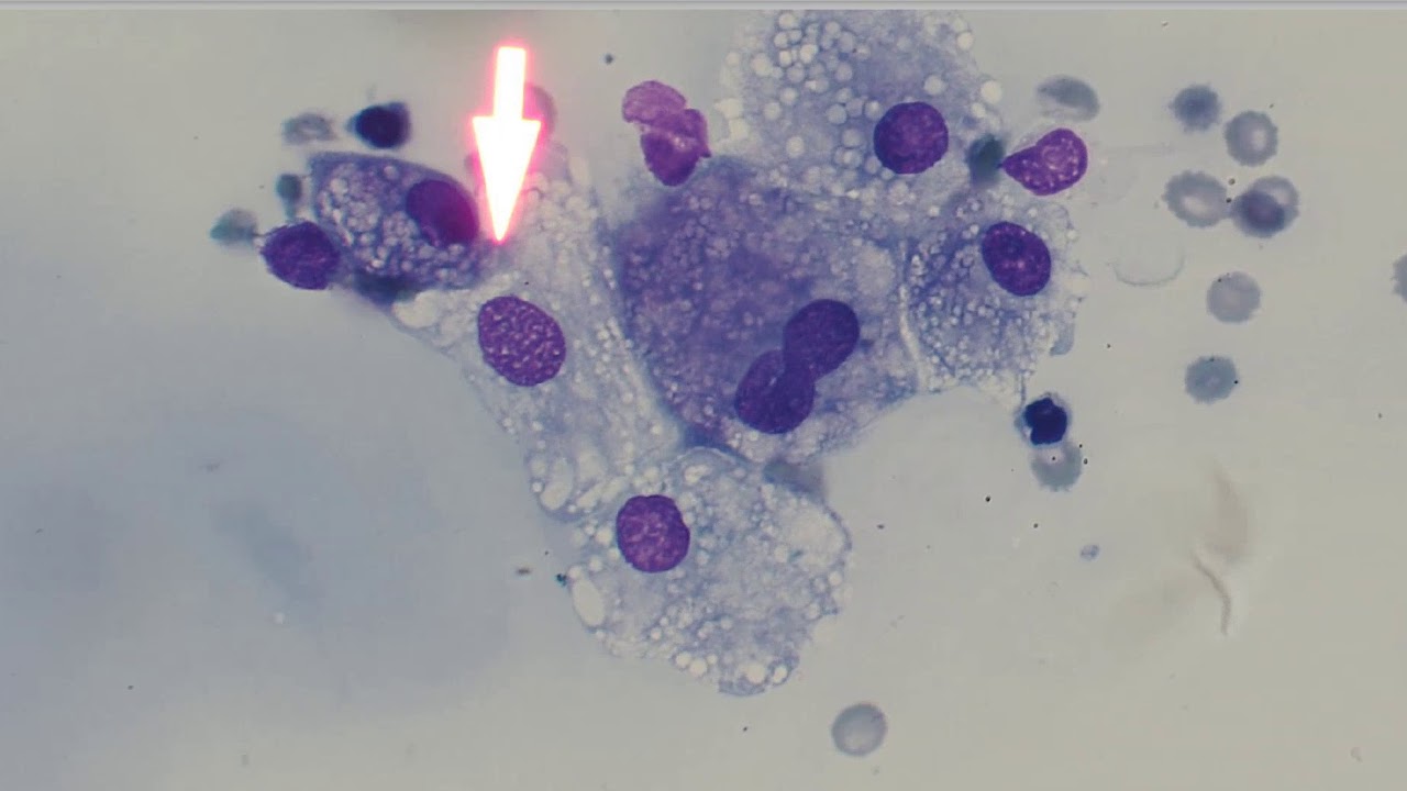 5 Minute Rounds: Salivary mucocele (ranula)