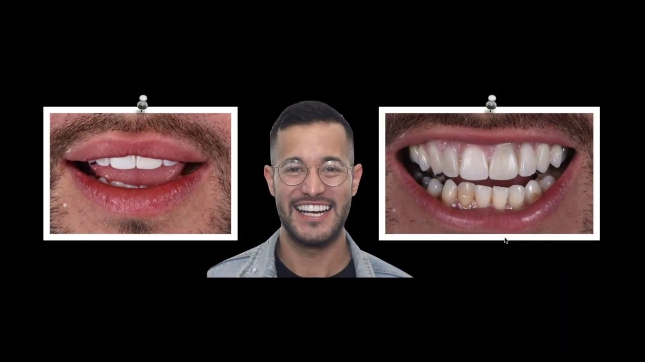 Feldspathic Ceramic Veneers  Milled, Micro Layered or through Refractory Foil with Peter Pizzi, MDT