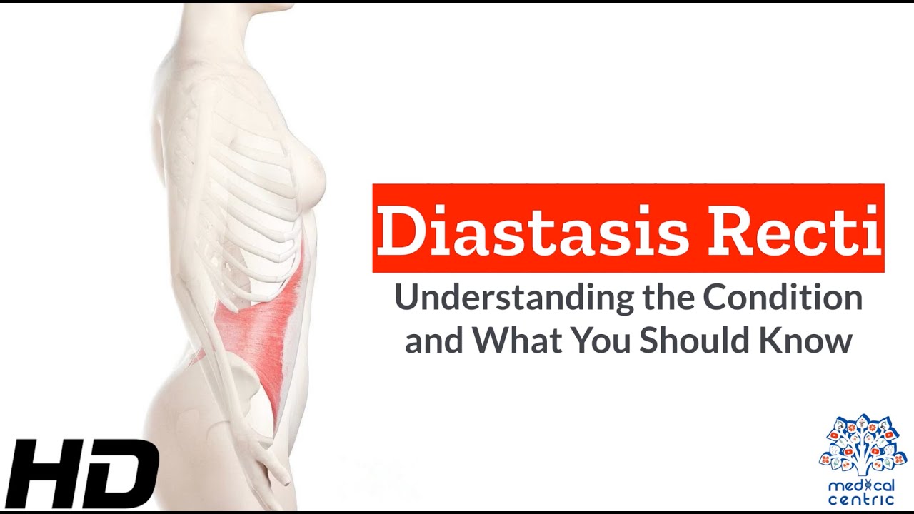 Diastasis Recti: What You Need to Know to Heal Your Core