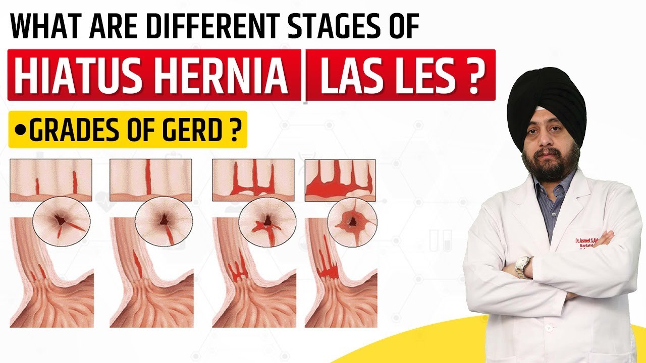 Grades of GERD | Stages of Hiatus Hernia | Hindi