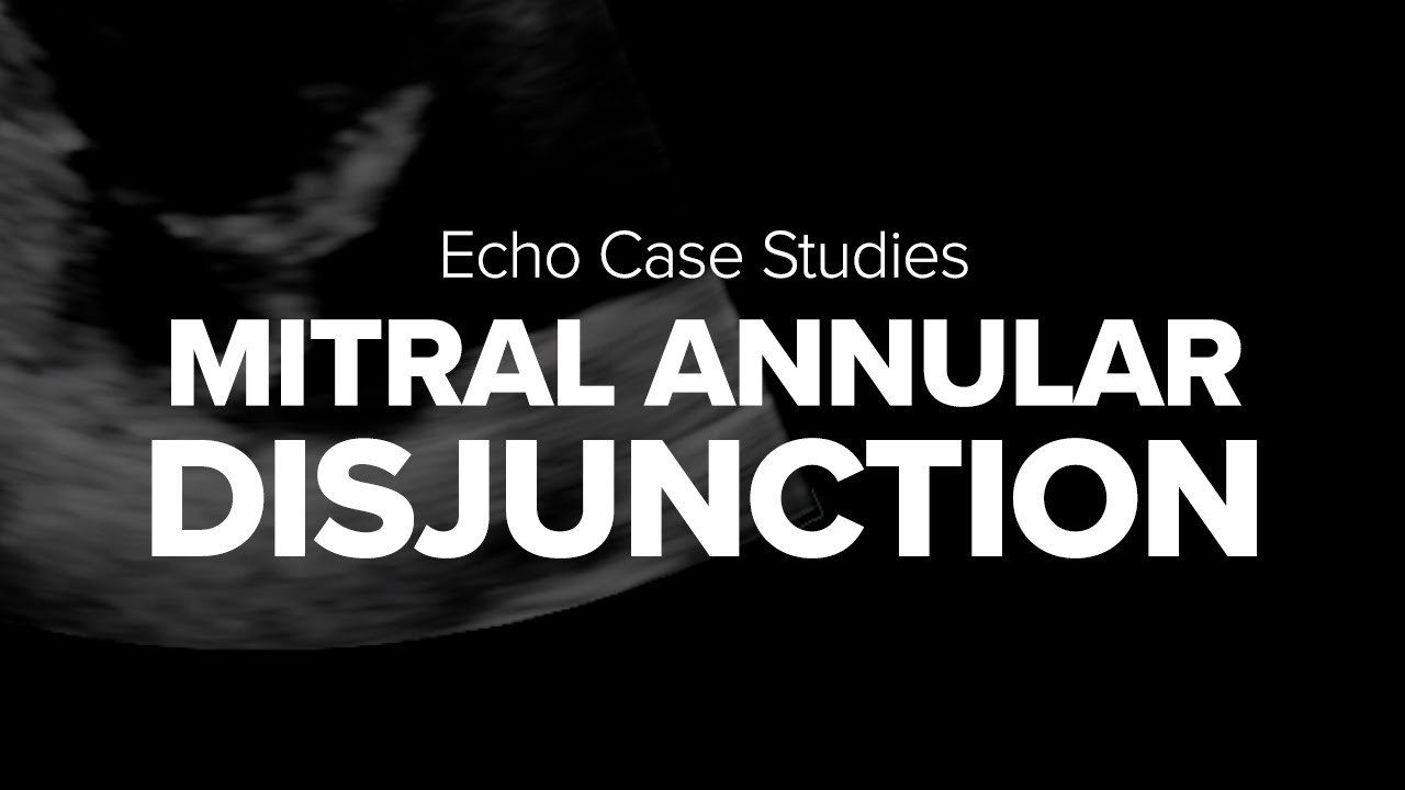 Echo Case #2 | Mitral Annular Disjunction