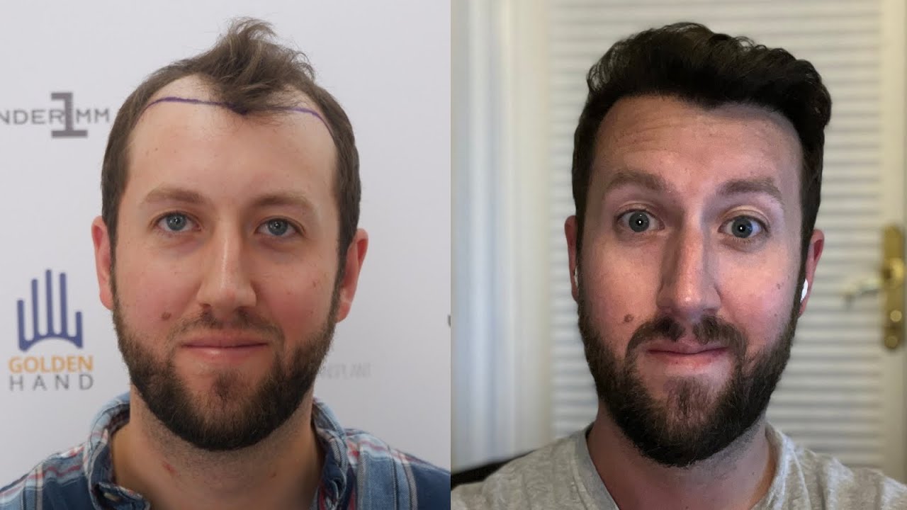 Day 365 - 12 Month Results - Fue Hair Transplant - Updated Hair Loss Prevention Routine