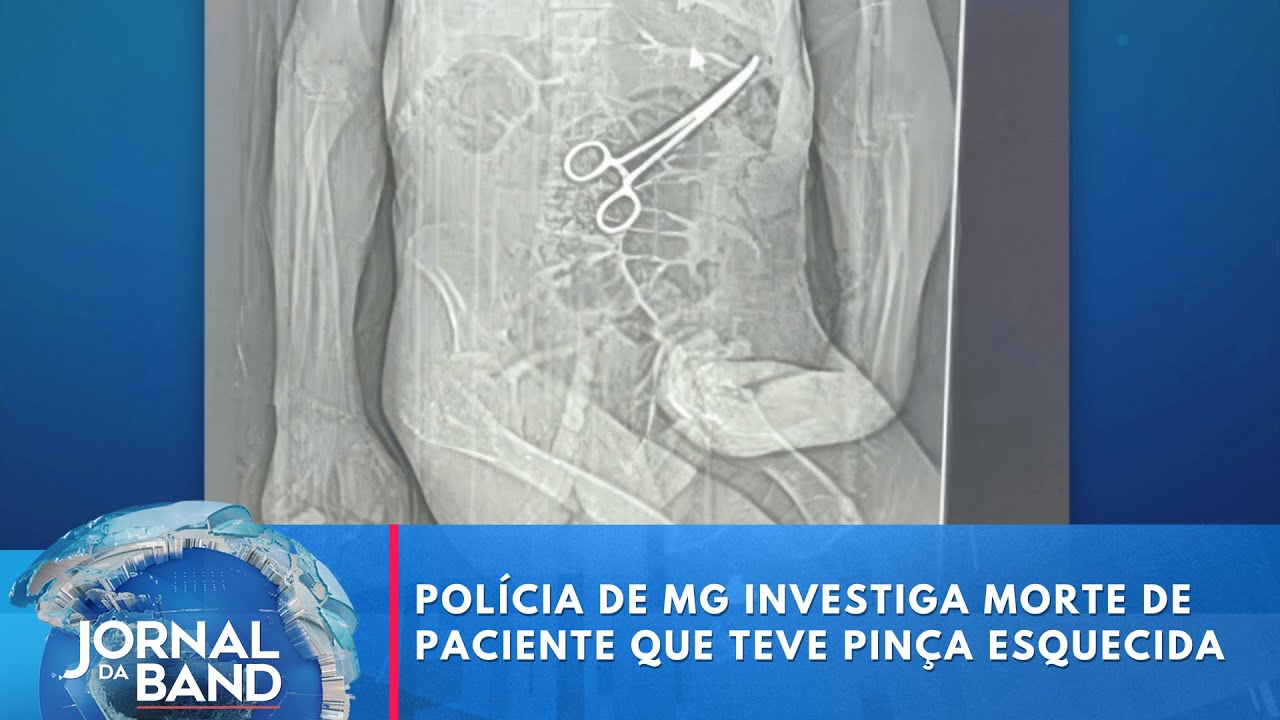 Polícia de MG investiga morte de paciente que teve pinça esquecida | Jornal da Band