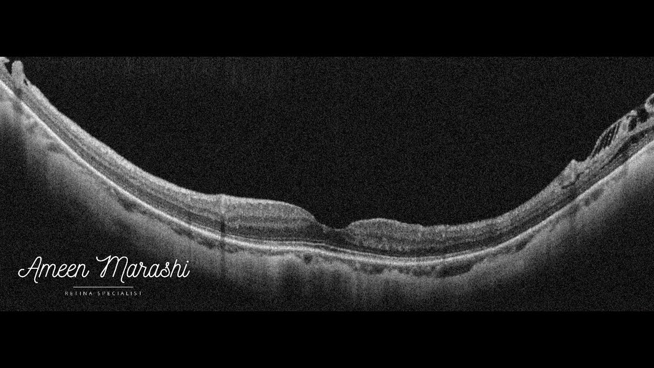 Course in clinical applications of OCT for macular diseases - Pathological myopia