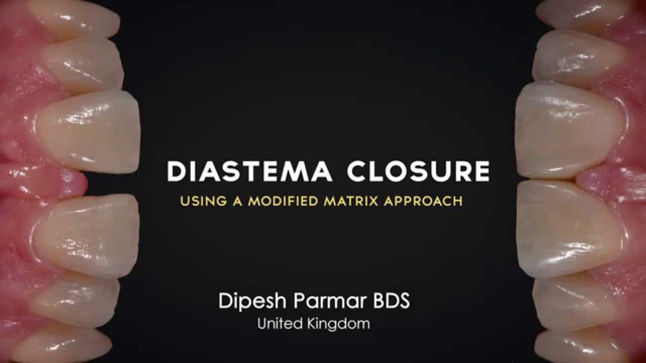Diastema Closure Renamel with Dipesh Parmar