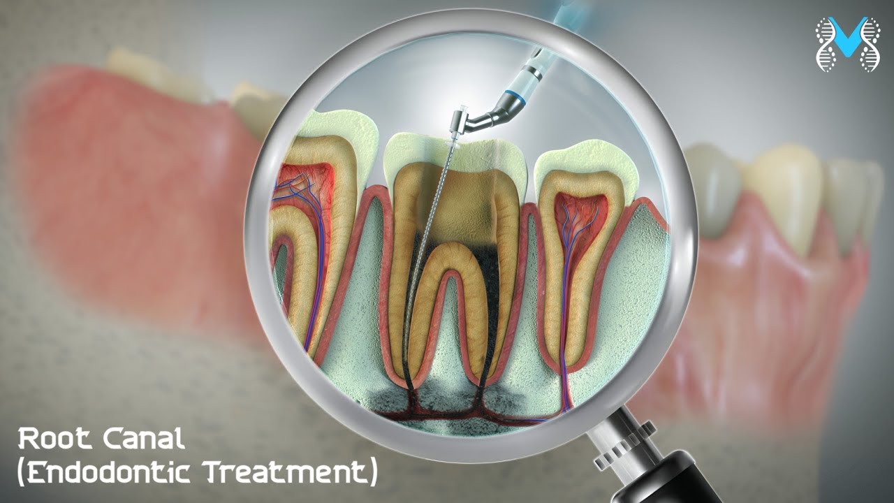 Root Canal (Endodontic Treatment)