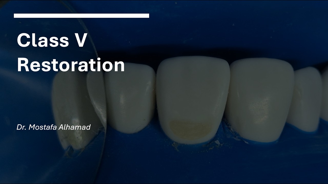 Class V Restoration for preclinical students